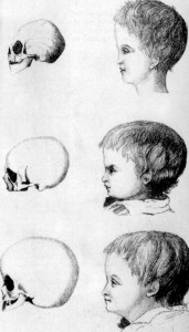 Phrenological View of Mental Deficiency